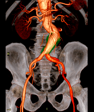 Pós Processamento de Imagens de Angiotomografia